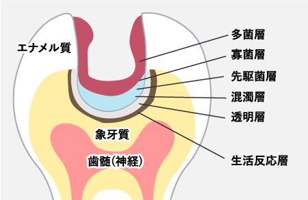 むし歯治療に局所麻酔は必須か？